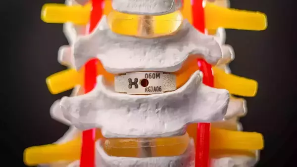 Anatomical model of vertebrae with an artificial spinal disc implant.